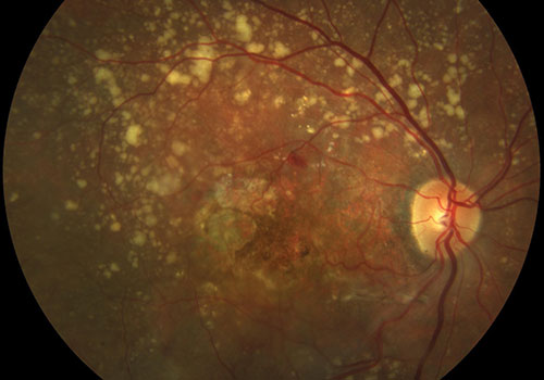 Macro di una degenerazione maculare senile