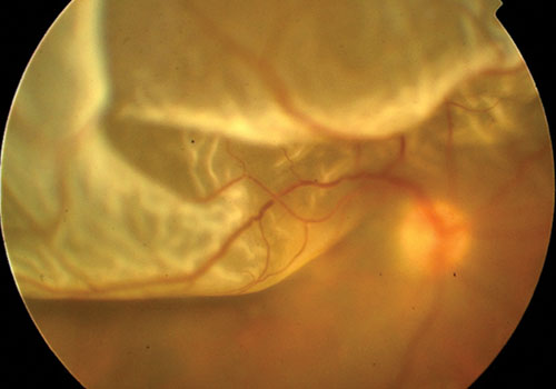 Macro dell'occhio con distacco di retina
