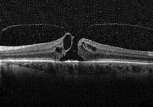 Dettaglio foro maculare
