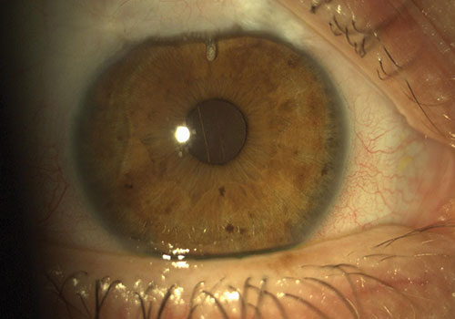 Occhio con glaucoma