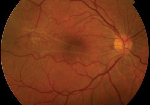 La membrana epiretinica e il "raggrinzimento" sulla retina